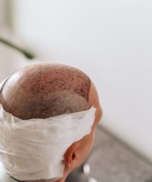 After hair transplantation surgical technique that moves hair follicles. Young bald man in bandage with hair loss problems.